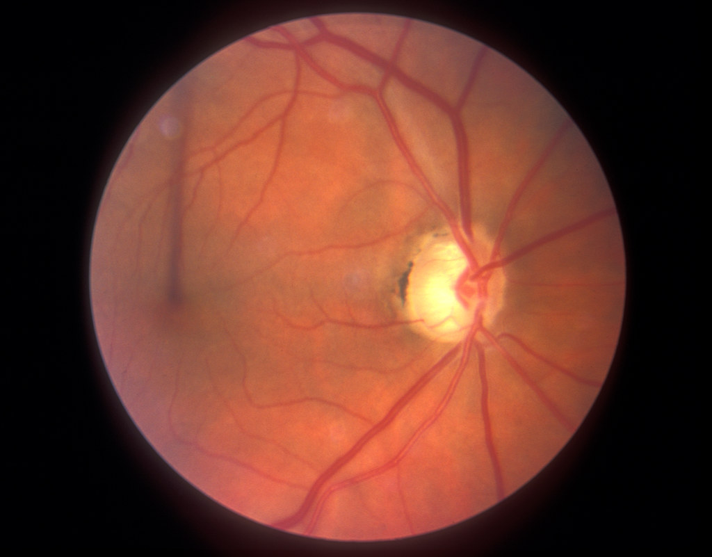 Glaucoma. eye laser surgery, eye operation, doctor