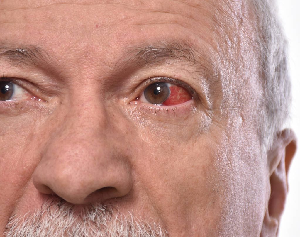cataract rupture, cataract surgery, ophthalmologist