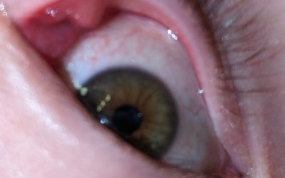 Can a Stye be Surgically Removed?